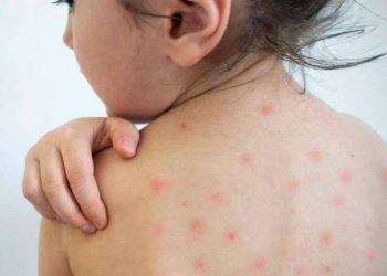 В ВОЗ рассказали о рекордном уровне заболеваемости корью в мире за более чем 20 лет