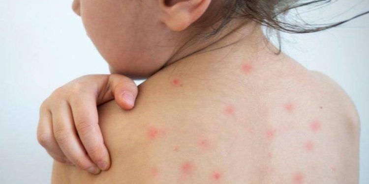 В ВОЗ рассказали о рекордном уровне заболеваемости корью в мире за более чем 20 лет