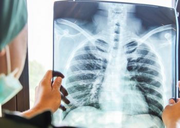 Cum arată plămânii unui bolnav Covid nevaccinat față de cei ai unui pacient imunizat. Imaginea publicată de un medic din SUA