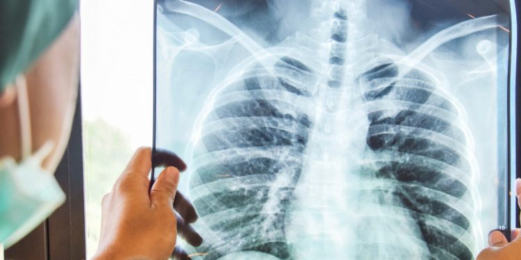 Cum arată plămânii unui bolnav Covid nevaccinat față de cei ai unui pacient imunizat. Imaginea publicată de un medic din SUA