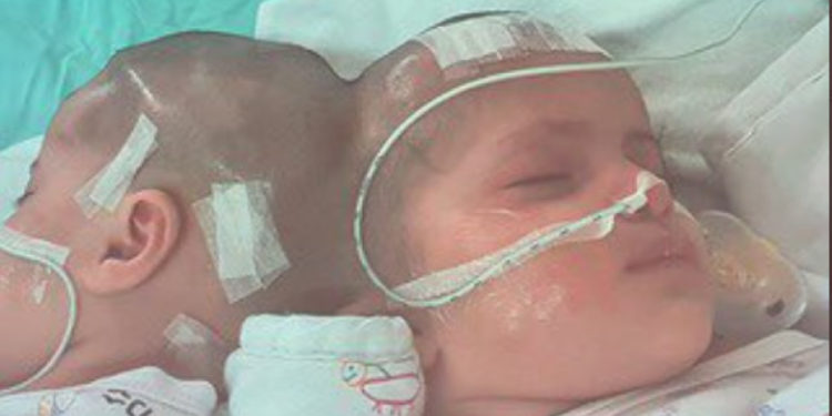 Operație extrem de rară și dificilă în Israel. Doua gemene siameze unite în spatele craniului au fost separate după luni de pregătiri