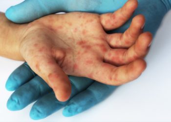 O infecție virală contagioasă se manifestă tot mai activ la copiii din țara noastră. Care sunt simptomele și cum poate fi tratată | VIDEO