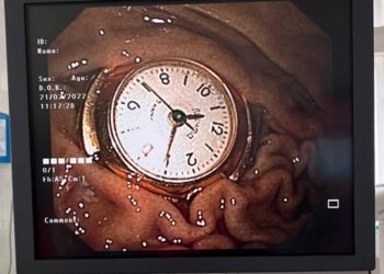 В Киеве трехлетний ребенок проглотил часы