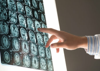 Ученые установили, что COVID-19 может влиять на мозг, как Альцгеймер