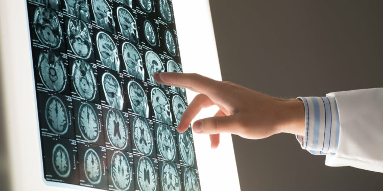 Ученые установили, что COVID-19 может влиять на мозг, как Альцгеймер