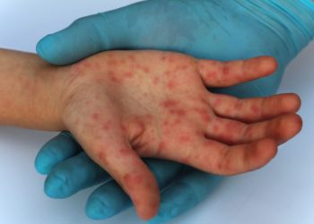 OMS avertizează despre creșterea numărului de infectări cu variola maimuței. Informații și recomandări, oferite de infecționiștii din Moldova | VIDEO