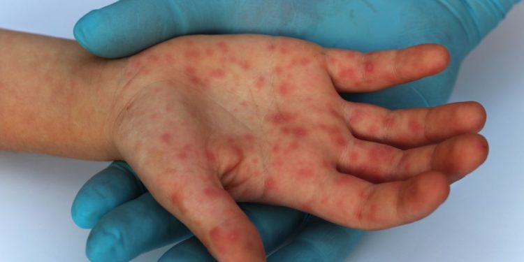 OMS avertizează despre creșterea numărului de infectări cu variola maimuței. Informații și recomandări, oferite de infecționiștii din Moldova | VIDEO