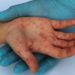 OMS avertizează despre creșterea numărului de infectări cu variola maimuței. Informații și recomandări, oferite de infecționiștii din Moldova | VIDEO