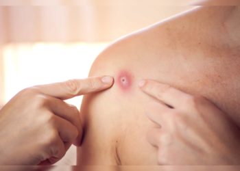 România va cumpăra un lot de vaccinuri împotriva variolei maimuței