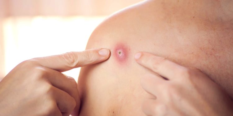 România va cumpăra un lot de vaccinuri împotriva variolei maimuței