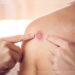 România va cumpăra un lot de vaccinuri împotriva variolei maimuței