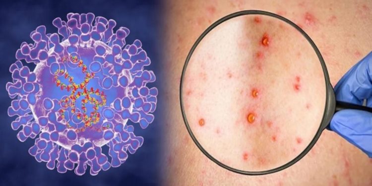 New York a declarat stare de urgență în caz de dezastru din cauza variolei maimuței