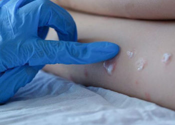 ANSP a pornit o anchetă epidemiologică în baza primului caz de variolă a maimuței înregistrat în Moldova. Care este starea pacientului | VIDEO