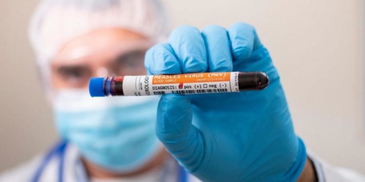 Ţara în care rujeola face ravagii: Aproape 160 de copii morţi şi mii de cazuri raportate. Decesele s-au dublat în doar câteva zile