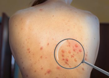 Detalii despre primul caz de variolă a maimuței înregistrat în Republica Moldova: Infectat este un cetățean străin, venit din SUA | VIDEO