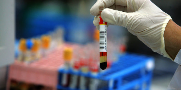 Un test de sânge pentru diagnosticarea bolii Alzheimer, autorizat în Japonia