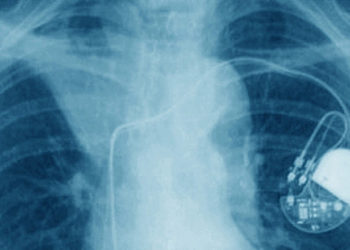 Medic din Iaşi, acuzat că a montat aproape 240 de stimulatoare cardiace luate de la cadavre. Cum își convingea pacienții