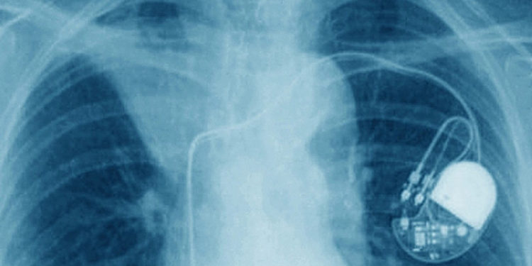 Medic din Iaşi, acuzat că a montat aproape 240 de stimulatoare cardiace luate de la cadavre. Cum își convingea pacienții