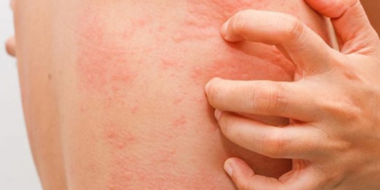 Число случаев растет: вспышка чесотки в Страшенском районе