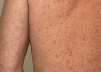 Specialiștii Centrului de Sănătate Publică, despre cazurile de scabie la Strășeni: Îndemnăm populația să respecte strict regulile de igienă | VIDEO