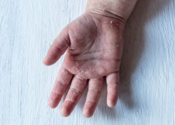 В Гагаузии зафиксировали вспышку скарлатины среди детей