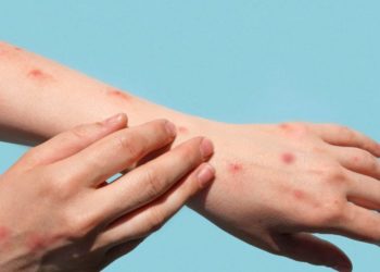 Впервые за три года: в Молдове зафиксирован случай кори