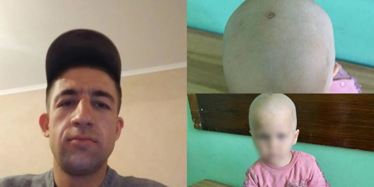 Caz șocant la Dubăsari: Un bărbat și-a stins țigara de capul fetiței fostei sale iubite