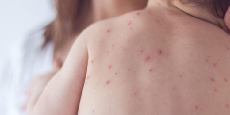 Новый случай кори выявлен в Молдове, у 3-летнего мальчика: пояснения НАОЗ