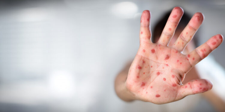 Ministerul Sănătății declară epidemie de rujeolă în România