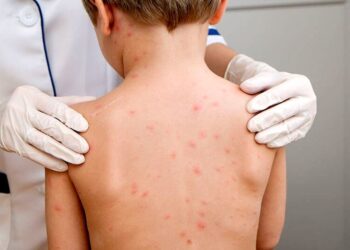 Cazurile de rujeolă în Europa şi Asia Centrală au crescut cu peste 3.000% față de 2022. Aproape un milion de copii n-au fost vaccinați