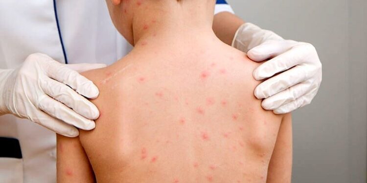 Cazurile de rujeolă în Europa şi Asia Centrală au crescut cu peste 3.000% față de 2022. Aproape un milion de copii n-au fost vaccinați