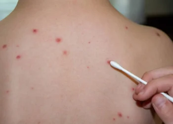 Alte patru cazuri de rujeolă, confirmate la centrul de plasament pentru refugiați din capitală