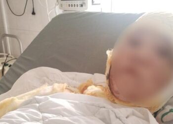 Caz șocant: O femeie și fiica ei de 7 ani, stropite cu acid de soț, au nevoie de ajutorul cetățenilor