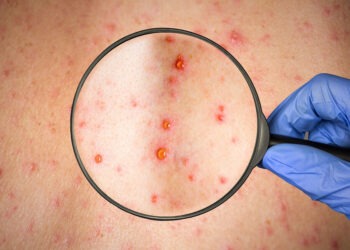 В Сынжерейском районе зафиксировали вспышку кори: заболели 11 детей. Их не привили из религиозных соображений