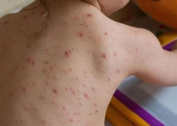 Focar de rujeolă în raionul Sîngerei: Numărul persoanelor infectate se ridică la 50