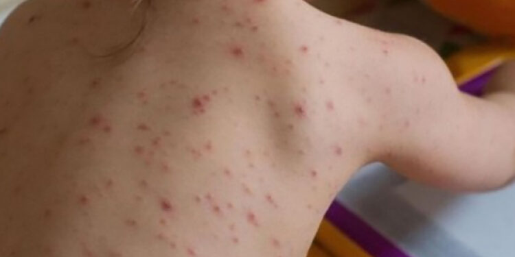 Focar de rujeolă în raionul Sîngerei: Numărul persoanelor infectate se ridică la 50