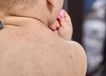 Aproape 800 de cazuri noi de rujeolă au fost înregistrate în România, în ultima săptămână