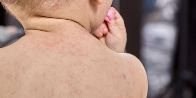 Aproape 800 de cazuri noi de rujeolă au fost înregistrate în România, în ultima săptămână