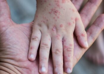 Peste 50 de cazuri de rujeolă la Sângerei. Autoritățile conving familiile să-și vaccineze copiii