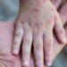 Peste 50 de cazuri de rujeolă la Sângerei. Autoritățile conving familiile să-și vaccineze copiii