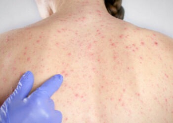 В Молдове растет заболеваемость корью