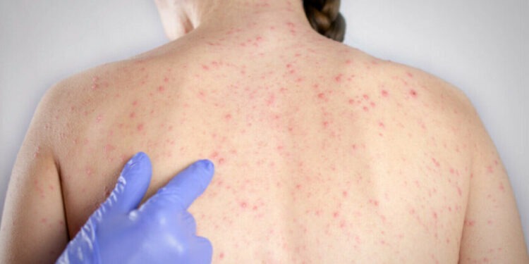 В Молдове растет заболеваемость корью