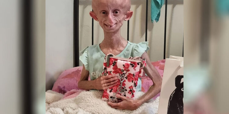 Девушка с синдромом преждевременного старения умерла в возрасте 19 лет