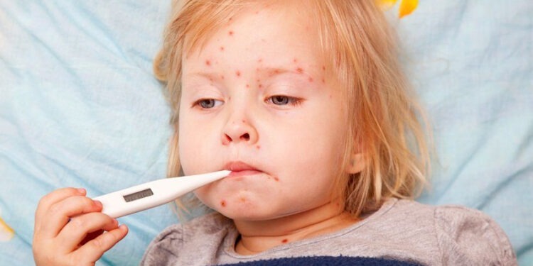 В 2024 году в Молдове зарегистрировали 210 случаев кори