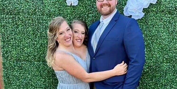 СМИ сообщили о беременности имеющих одно тело сиамских близнецов