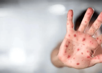 Alertă medicală: 8 cazuri de rujeolă confirmate în Chișinău