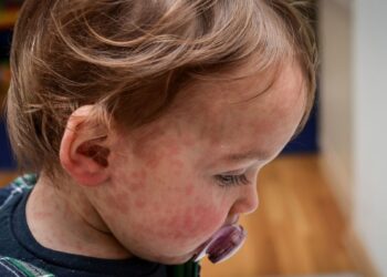 Patru cazuri de rujeolă, confirmate în capitală: Pentru alte șapte se așteaptă rezultatele de laborator