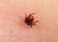 Creștere a cazurilor de boală Lyme și rujeolă în Chișinău