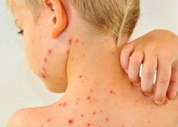 В Молдове регистрируют всё больше случаев кори и коклюша