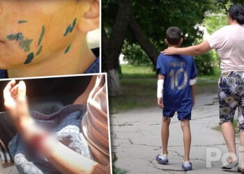 В Пелинии на ребенка напала соседская собака: он госпитализирован